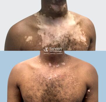 Vitiligo